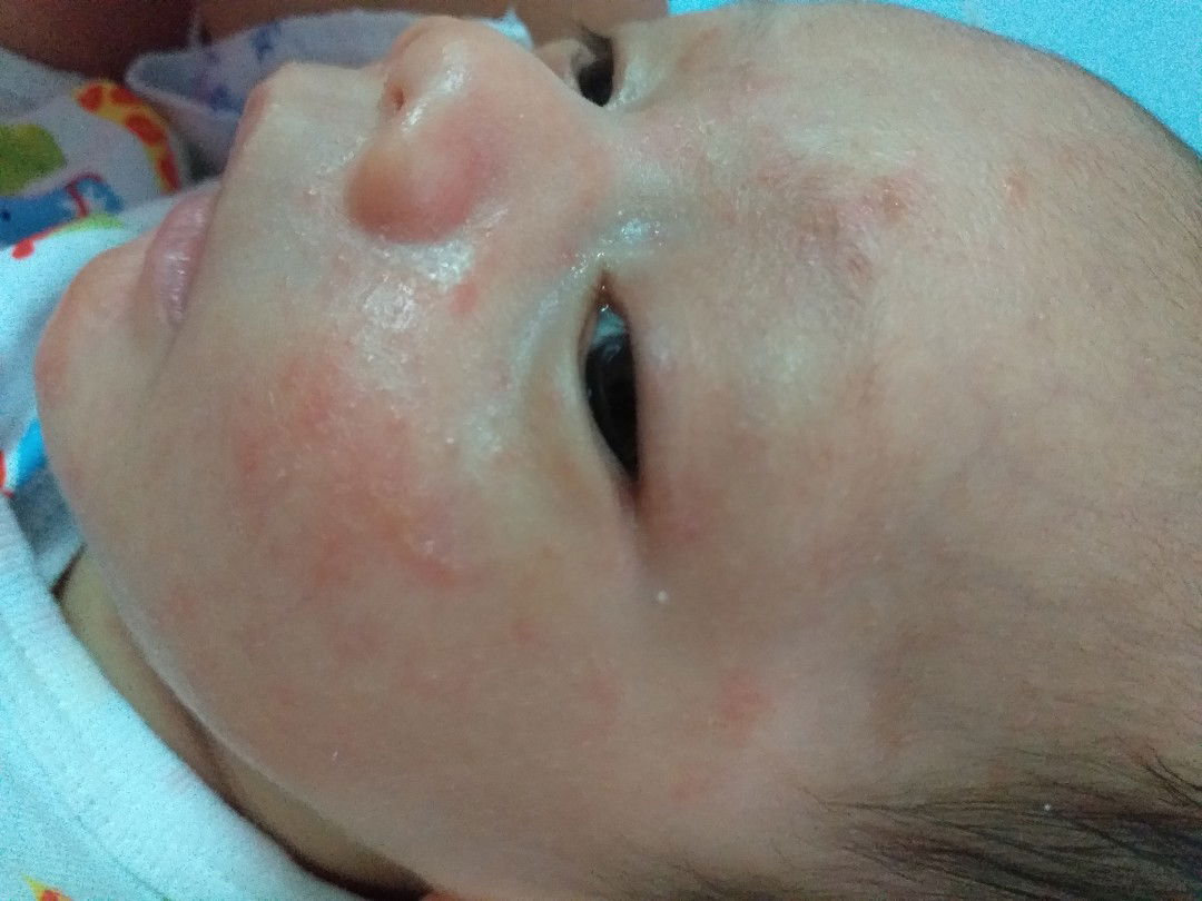 หน้าเป็นผื่นแบบแห้งๆ