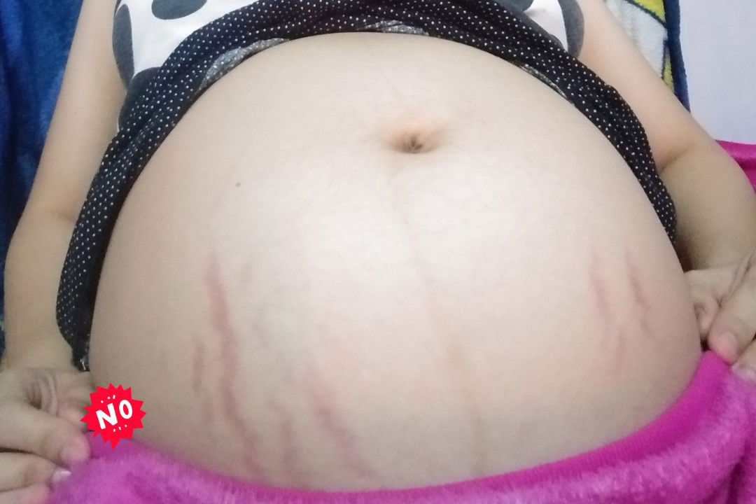 Baru muncul strechmark diusia kehamilan 7bulan