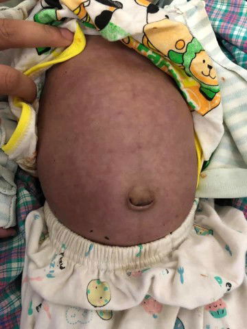 akibat Mpasi dini ( dan terjadi lagi )