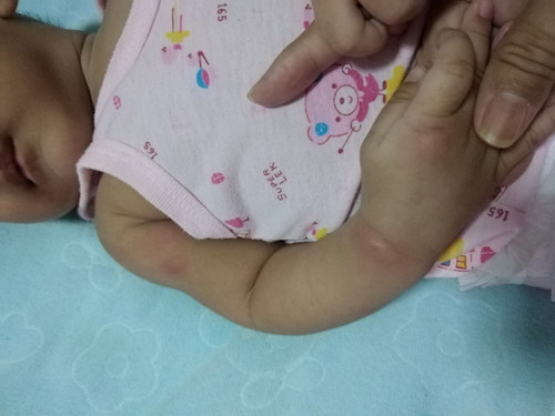 มีใครเจอปัญหาแบบนี้บ้างค่ะลูกเป็นผื่นเหมือนยุงกัดบวมแดง