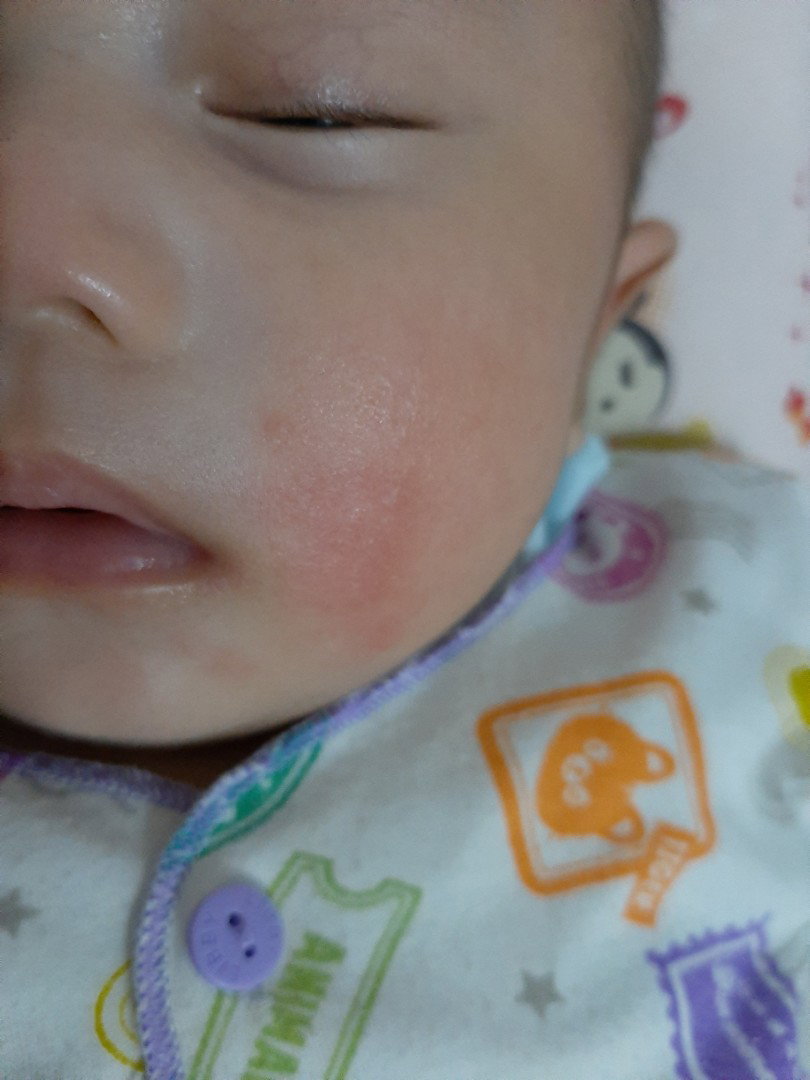 merah pada kulit bayi