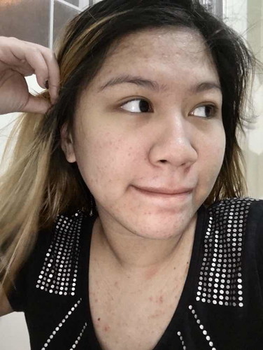 Pimples/Acne