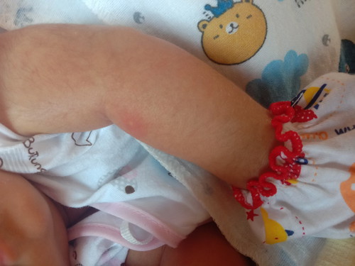 น้องอายุ11วันมีตุ่มแบบนี้ขึ้น