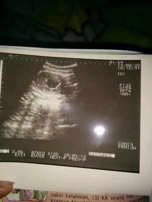 kehamilan