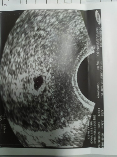 BLIGHTED OVUM