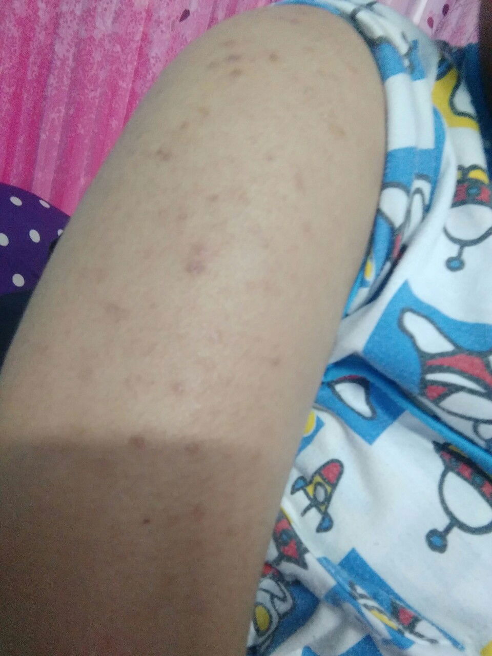 เป็นผื่น