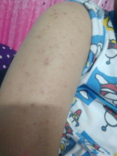 เป็นผื่น