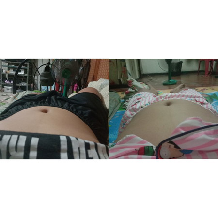 ฝังยาคุมแล้วแต่ทำไมอยู่ดีๆเป็นแบบนี้