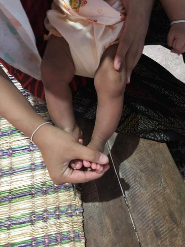 ขาแค้โค้งงอ