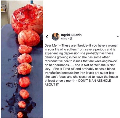 Fibroids