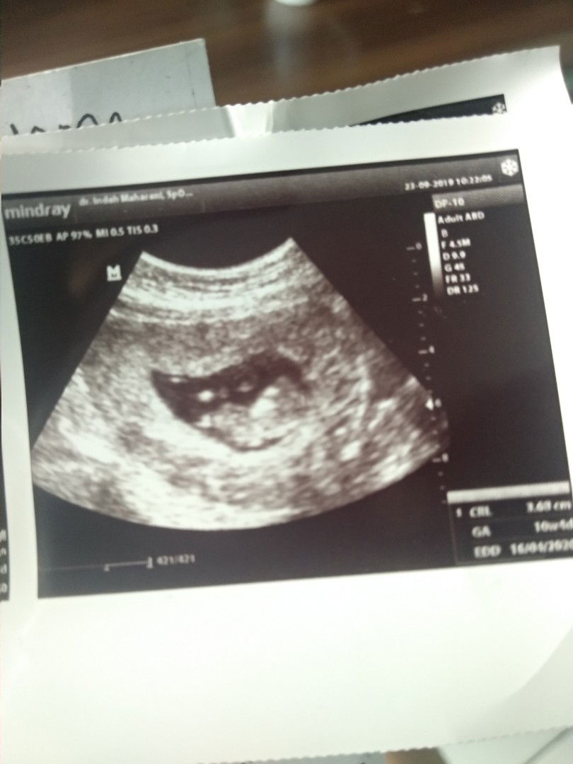 Senengnya Stelah USG