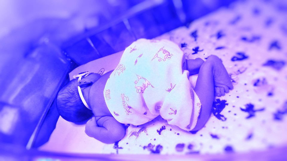 ภาวะเด็กตัวเหลือง คืออะไร มีคำตอบ