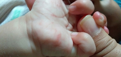 tagan anak ada merah2 macam gatl2.adakah normal