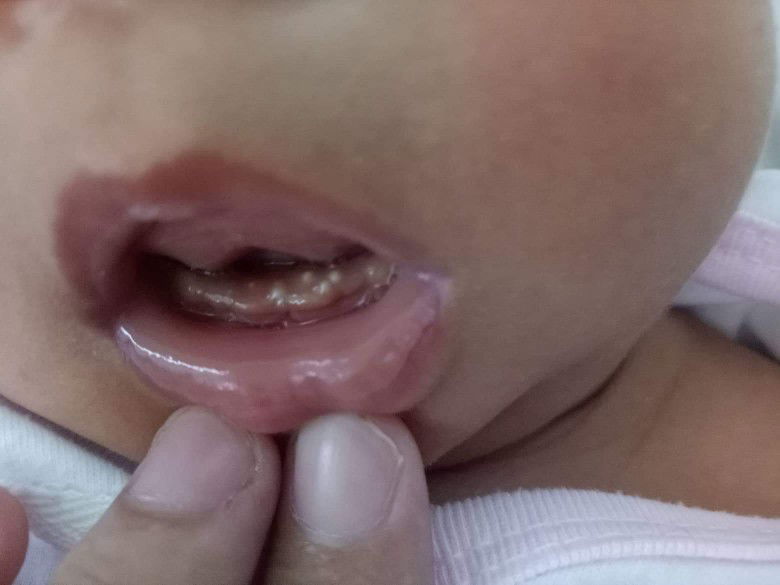 1 Month Old Gums Has Pus