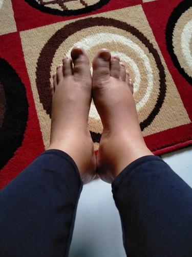 kaki bengkak