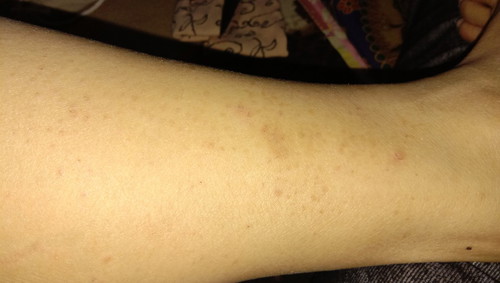 bintik2 merah saat hmil muda