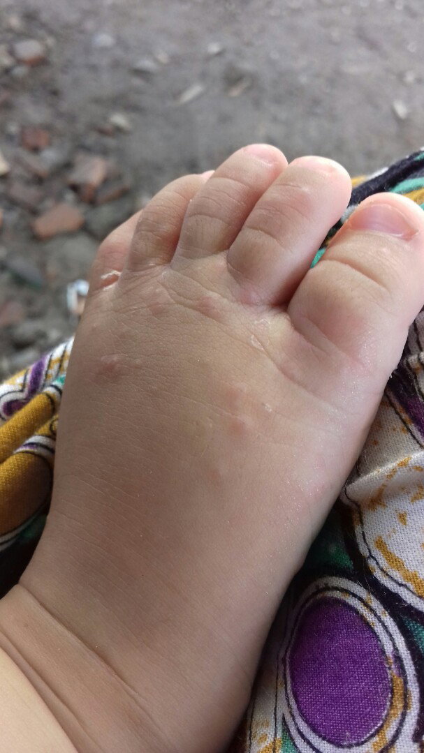 kulit adek gatel2