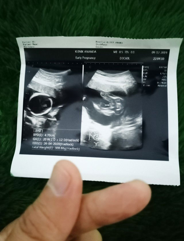 beda usia di USG dengan hpht