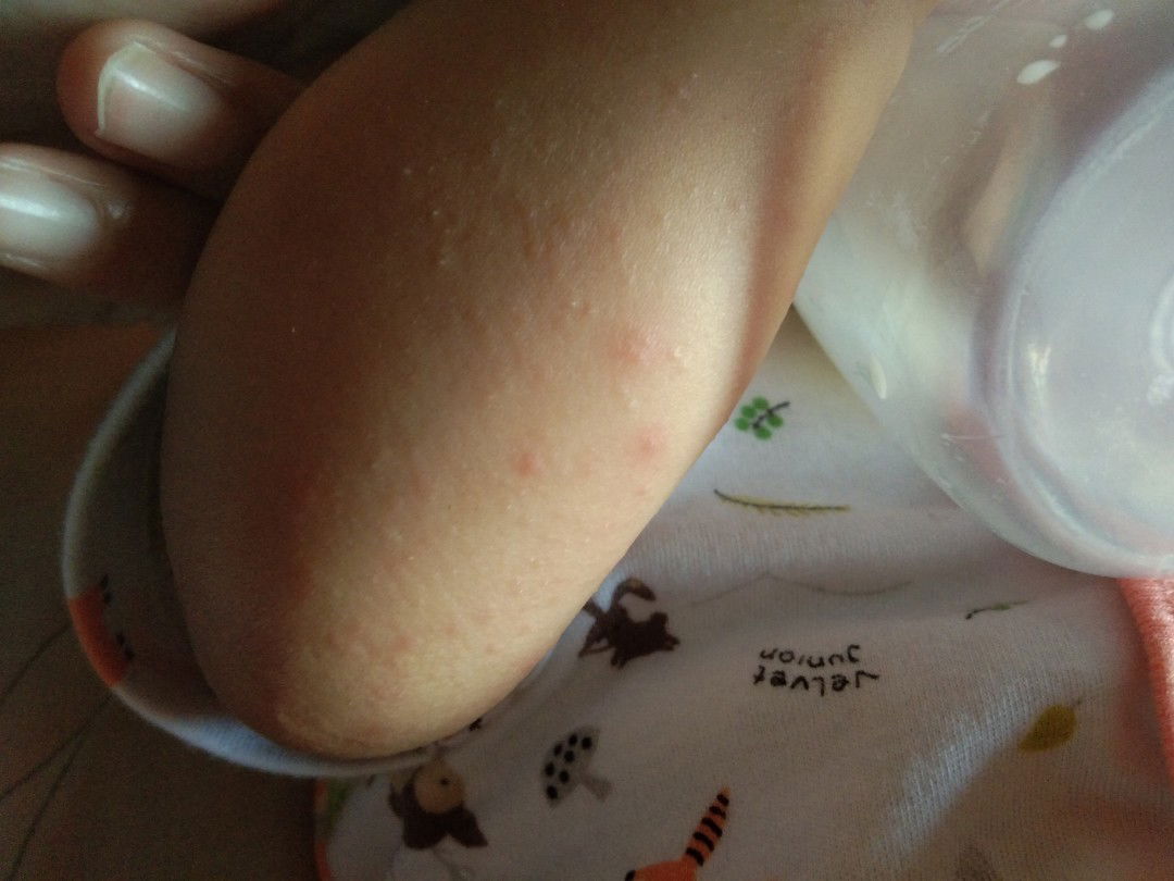 kulit bayi bintik merah