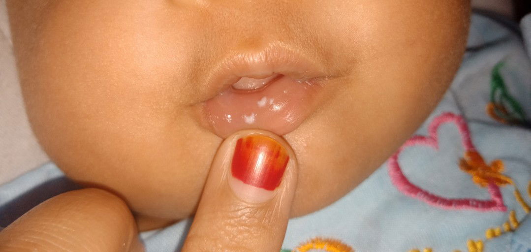 bercak putih dibibir