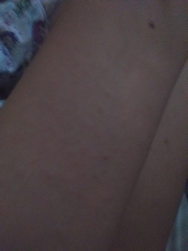 itchy rashes