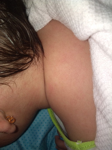 can someone help me!! after fever rashes