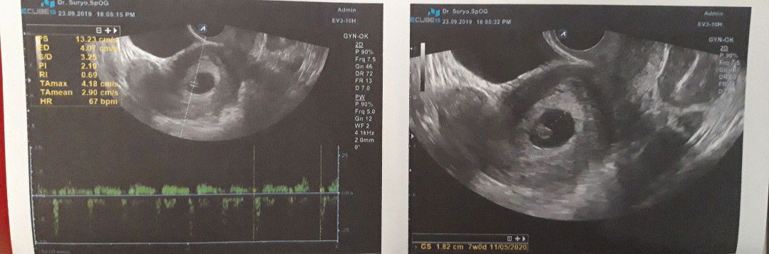 alhamdulillah, berbagi sedikit ya bun,.