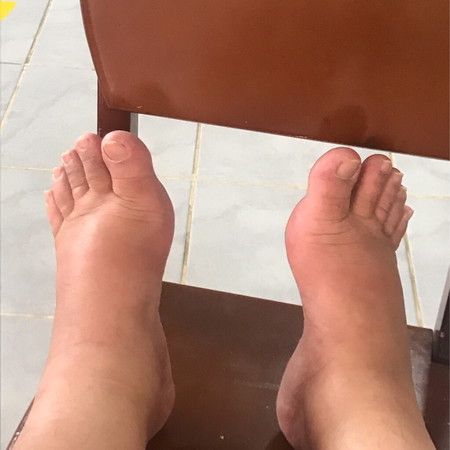 บ้านไหนเท้าบวมแล้วบ้างค่ะ