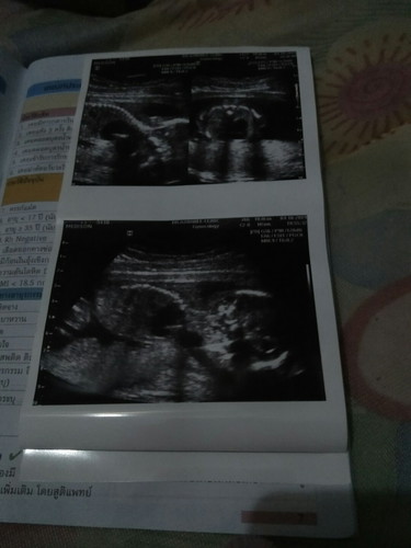 เจอถุงในปอด