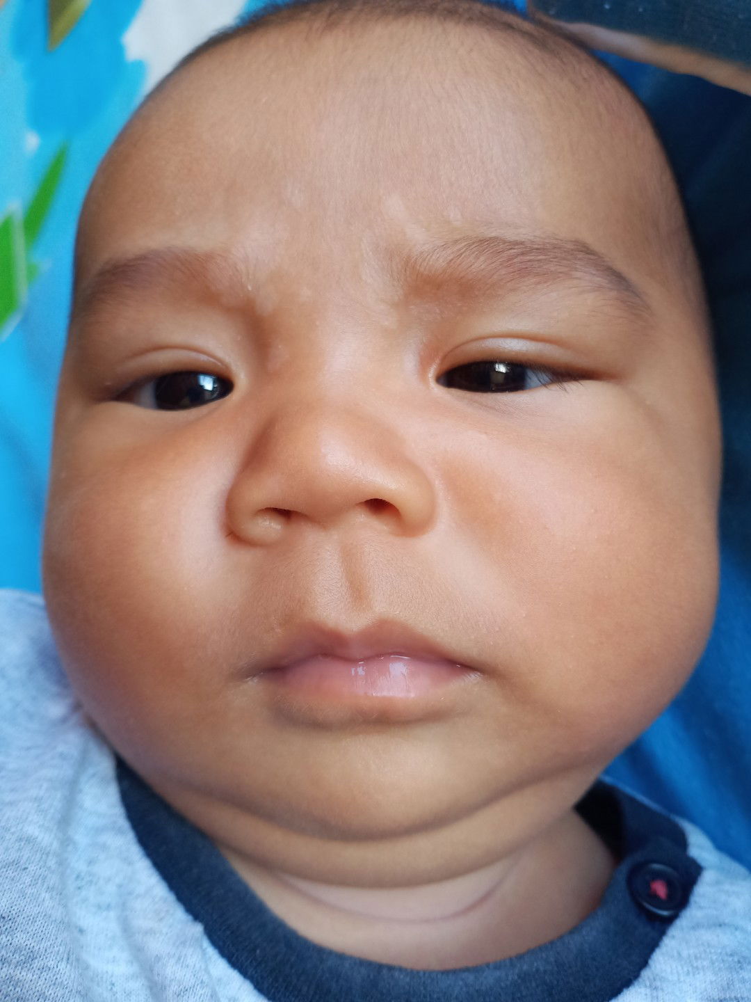 เกลื้อนน้ำนม