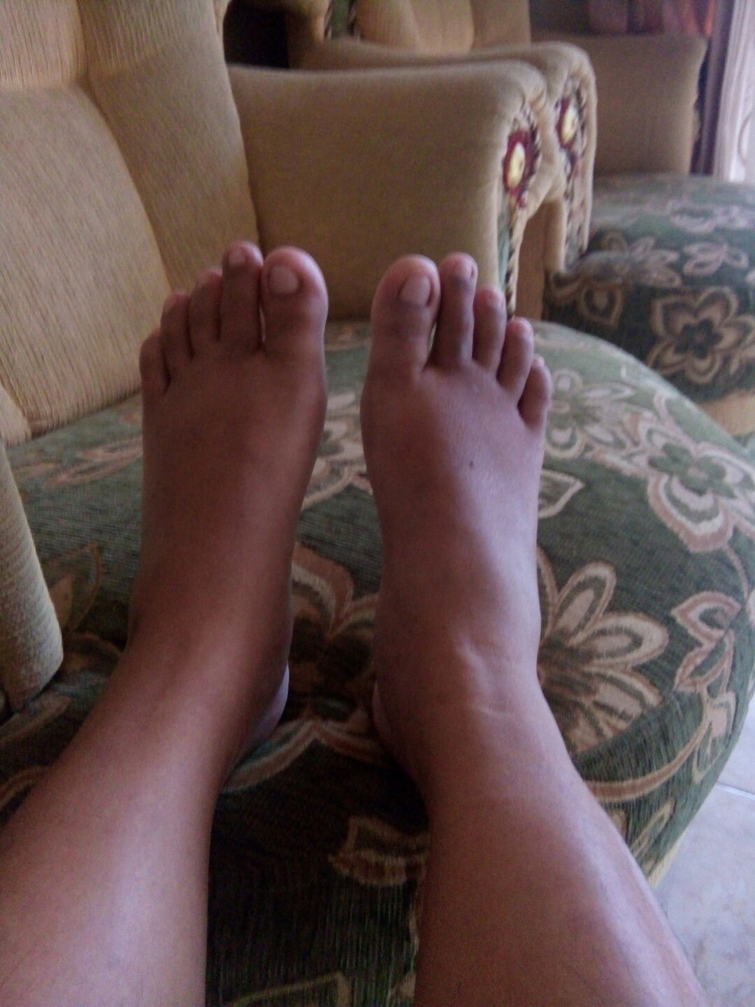 Cara atasi bengkak??