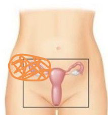 ปวดมดลูกด้านขวา