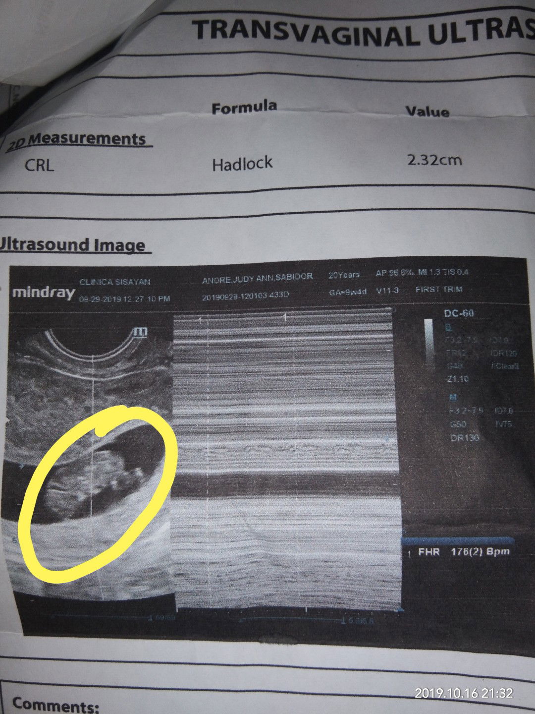 9weeks tsv ultrasound