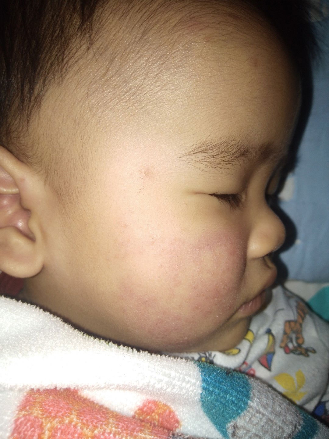 อยากสอบถามเเม่เเม่ เมื่อลูกมีผื่นขึ้นหน้า ควรทำยังไงดีค่ะ?