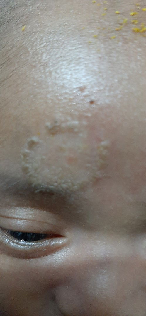 kurap/kadas pada bayi