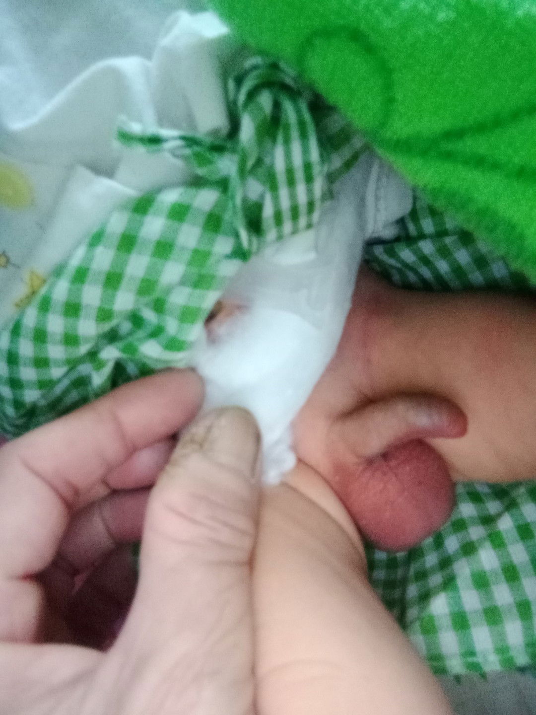 cu bị vẹo và hơi xưng. e lo quá