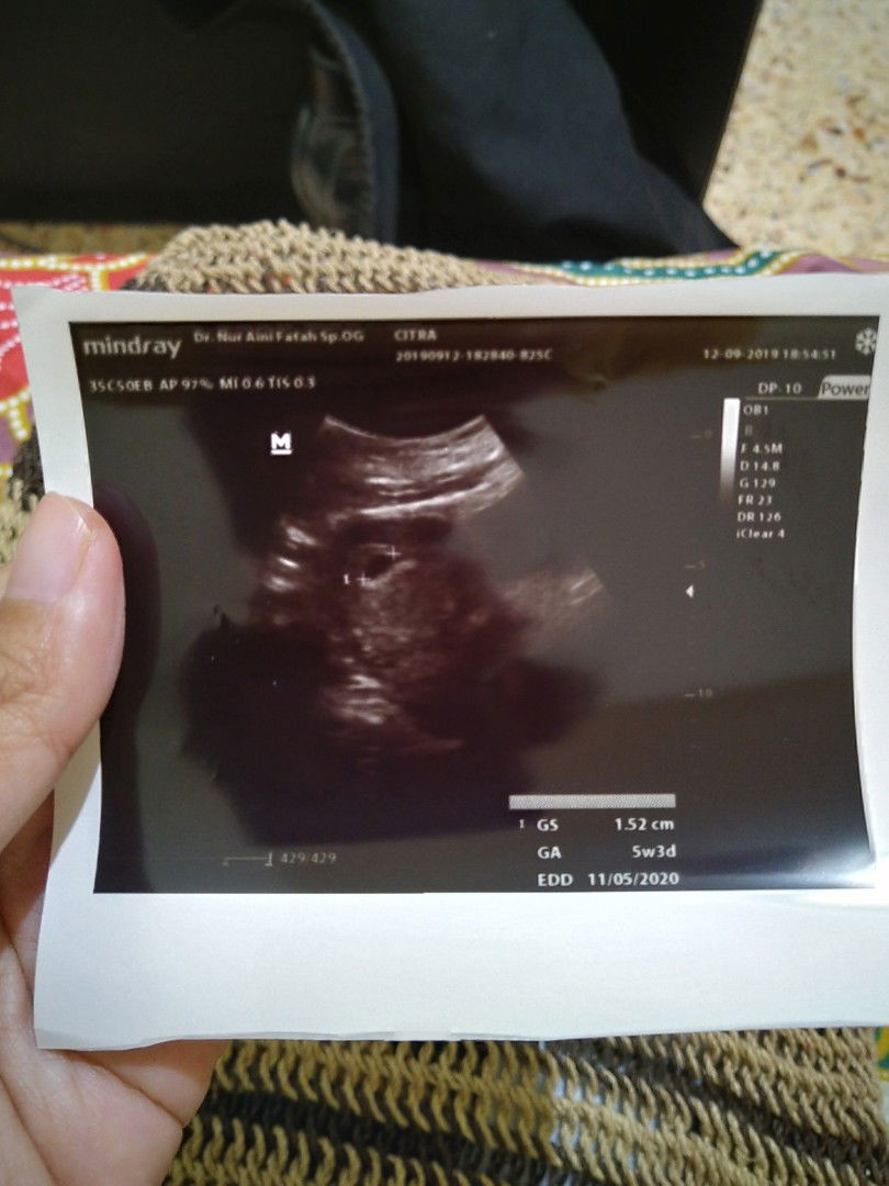 hamil 7 Minggu, tapi janin belum terlihat?