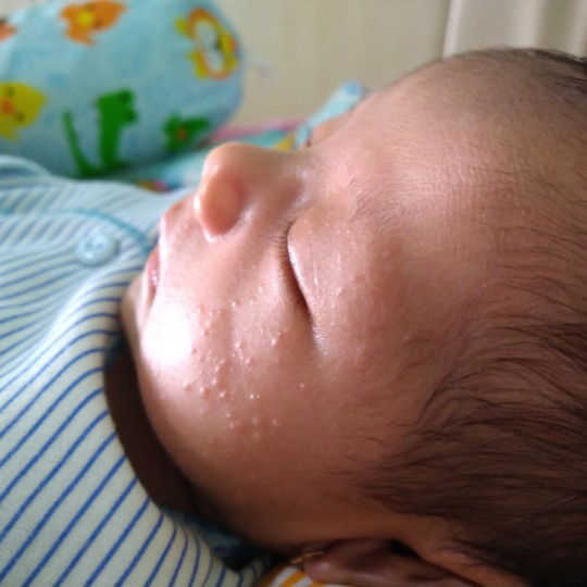 bintil di wajah dan telinga bayi (keringat Buntet)