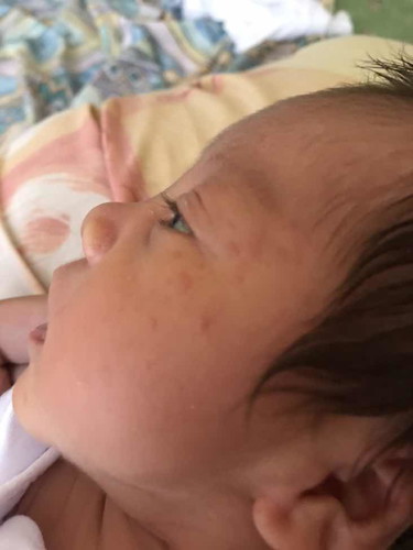 Rashes ni baby?