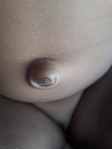 ลูกได้ 1 เดือน 15 วัน สะดือแแบบนี้ปกติหรือป่าวค่ะ อยากถามเเม่ๆดู