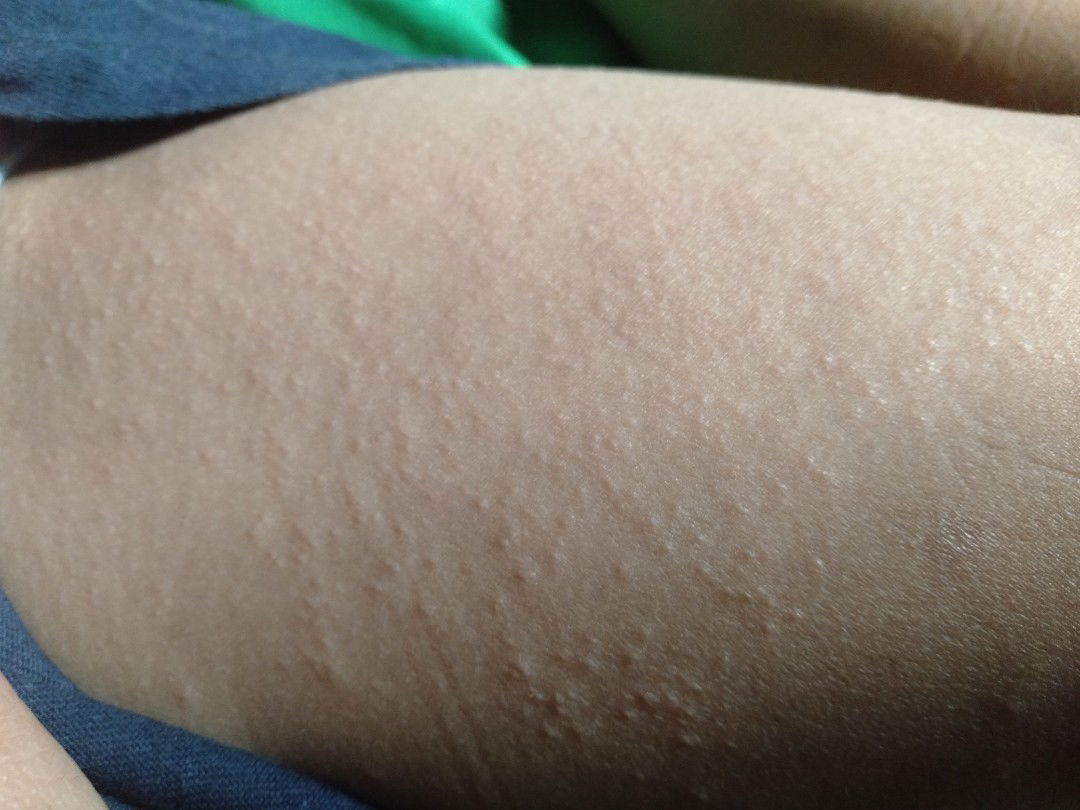 biang keringat / alergie ?