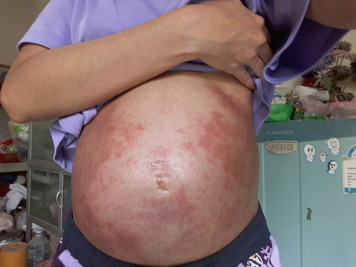 ผื่นคัน 23+5 w