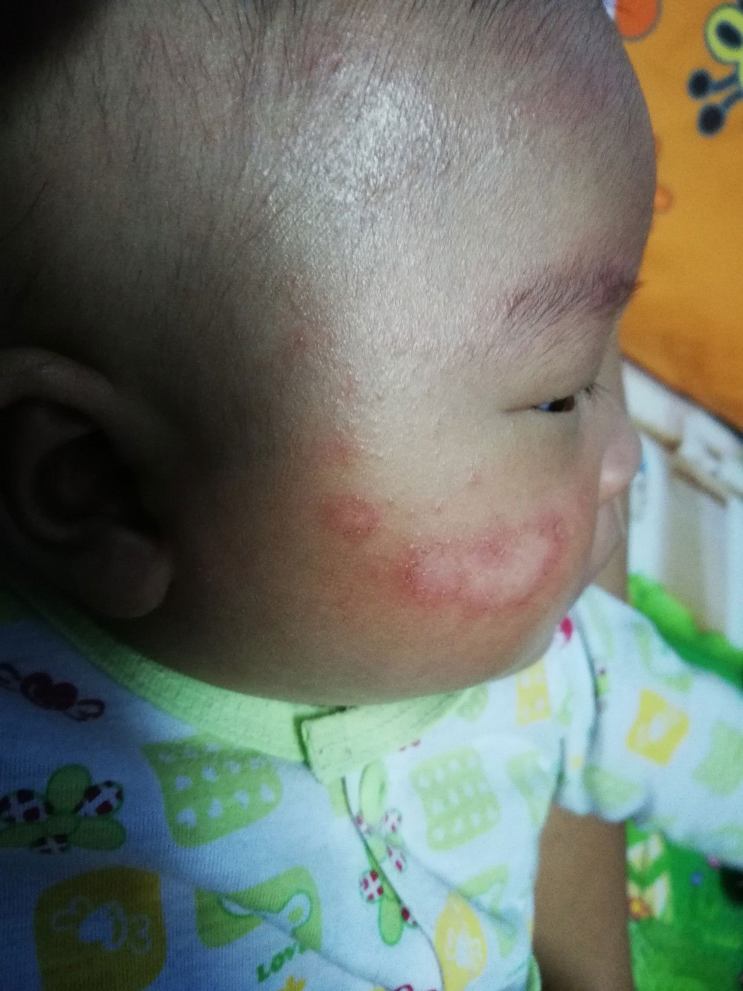 ผื่นแพ้