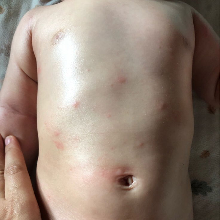 Kemerahan pada kulit bayi