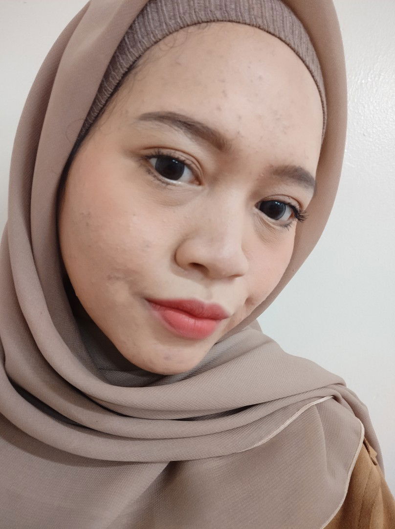 Muka Beruntusan dan Berjerawat Saat Hamil