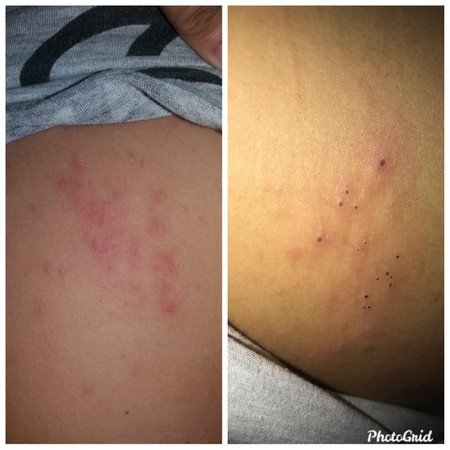 ini herpes bukan ya?