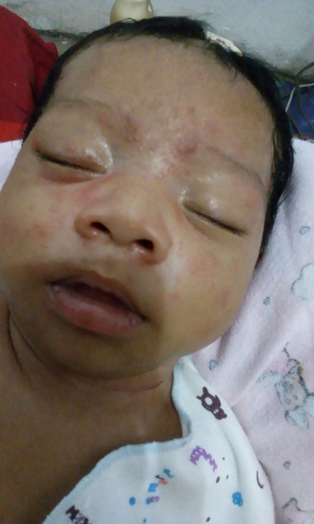 bintik muka diwajah semakin parah