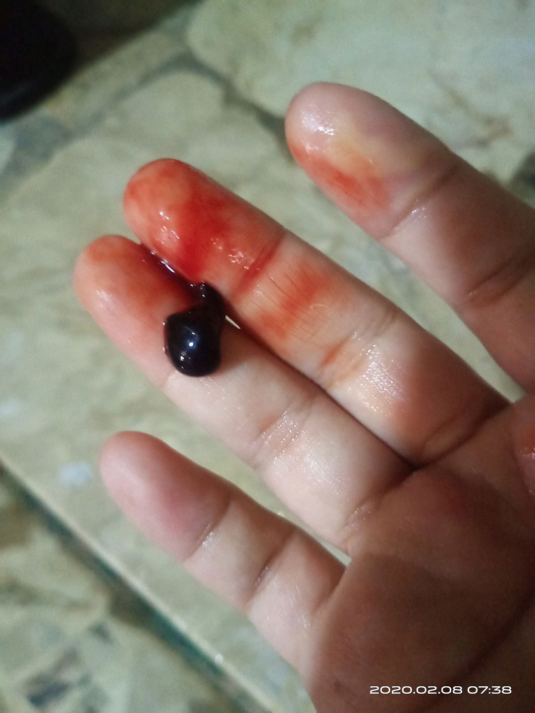 preterm labor, admitted at 28 weeks