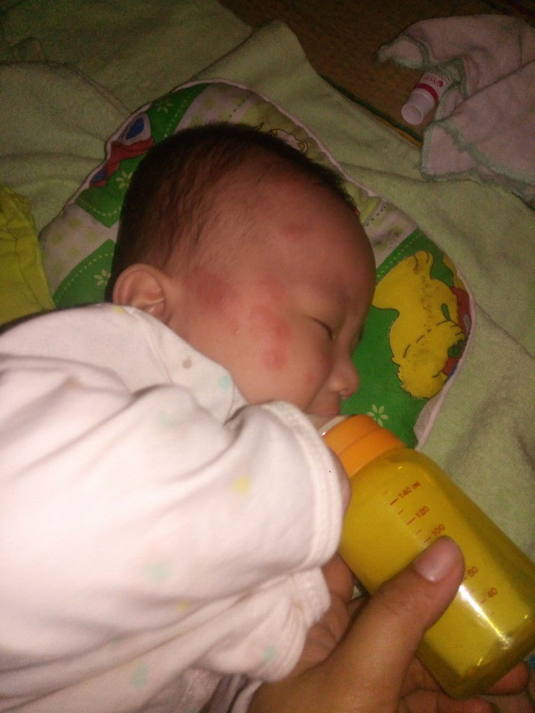 da bé bị nổi mận đỏ