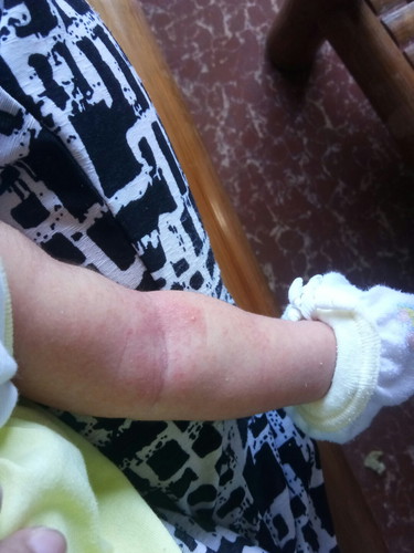 rashes